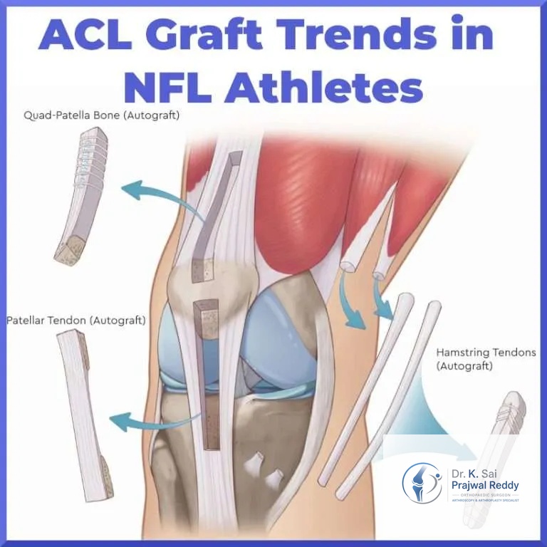 Choosing the Right ACL Graft: Your Options Explained